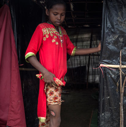 Jente p&aring; 12 &aring;r viser frem et skudds&aring;r hun fikk da hun l&oslash;p fra soldater i Myanmar.